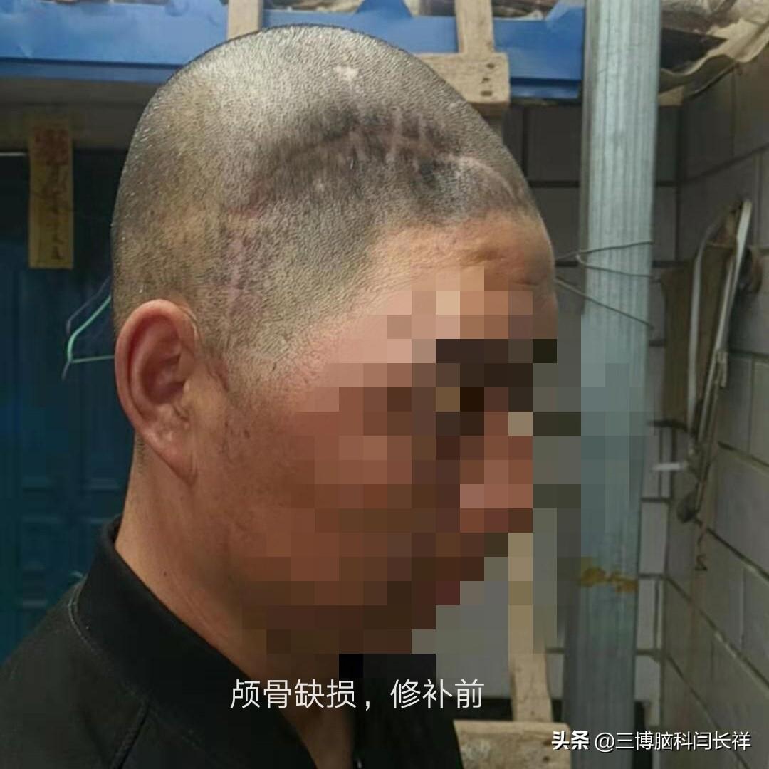开颅术后颅骨还能不能用