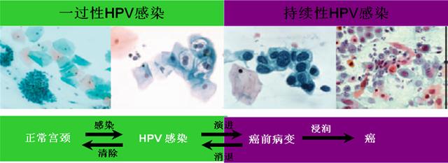 从HPV感染到宫颈癌要经历哪些过程？