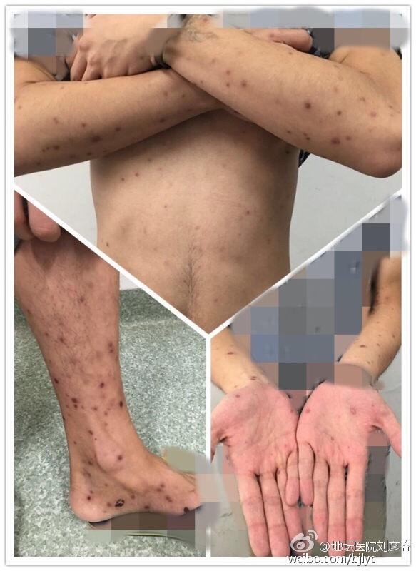 梅毒治疗及随访注意事项