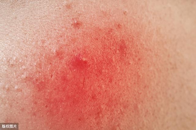夏天细菌、真菌、蚊虫、螨虫因素致皮肤问题层出不穷，如何应对？