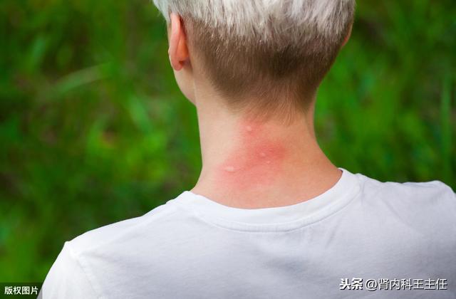 夏季蚊子太烦人？为什么蚊子总咬你？专家告知这几类人是招蚊体质