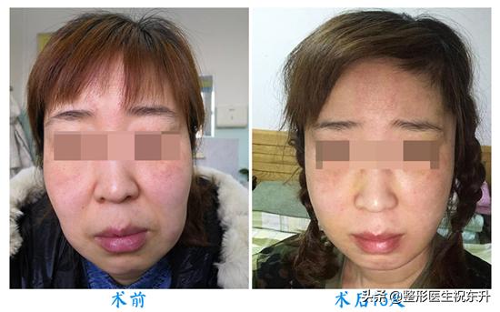 做线雕和拉皮手术后的感觉一样吗？听听做过的怎么说