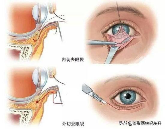 你还在用"滚鸡蛋"祛眼袋？给"有眼袋"的求美者，一些真实的建议