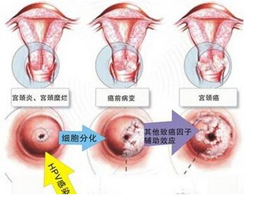 宫颈锥切后仍有高度病变，还要一切再切吗？