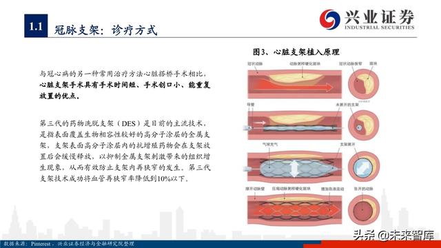 医疗器械之冠脉支架行业深度研究与投资策略