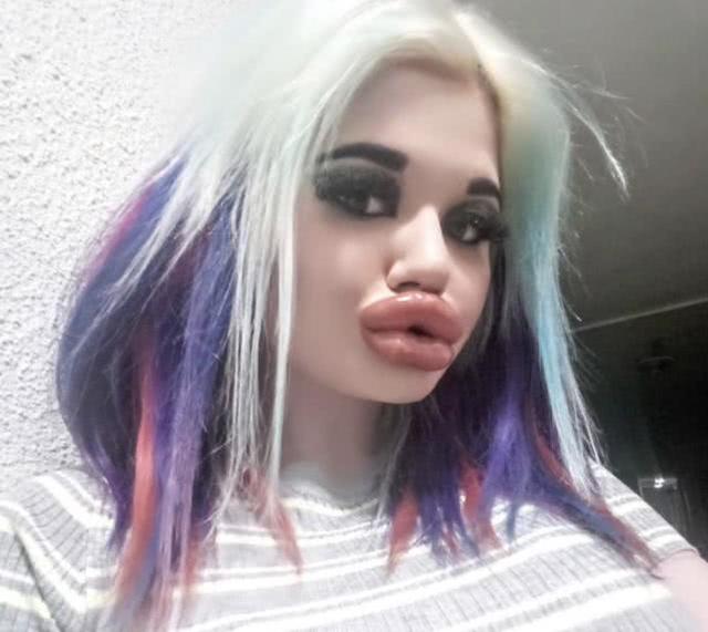 保加利亚一个女子狂爱丰唇，上瘾20次后，悲剧发