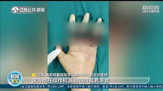 断指：7小时手术成功再植 大学生暑期兼职被切断四指