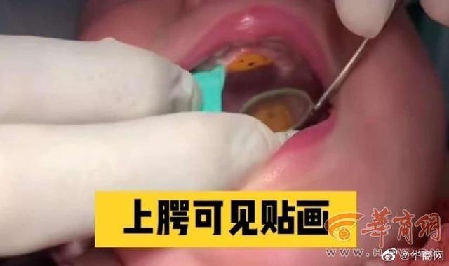 西安1岁女童口腔有贴画2周后发现，医生：幼儿禁