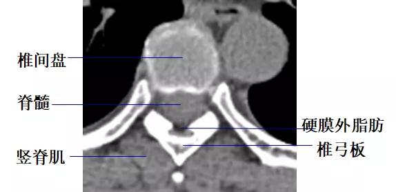 颈椎、腰椎CT常见病变，你都了解吗？