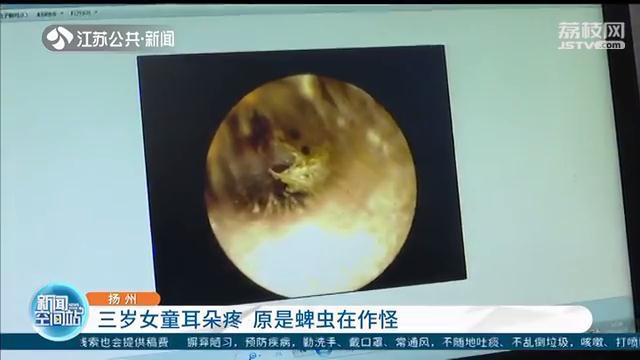 三岁女童耳朵疼 医生从耳道取出一只活蜱虫，还已经产卵