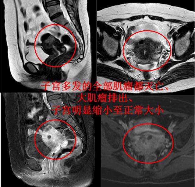 看看引发月经量过多、贫血的<!--HAODF:8:zigongjiliu-->子宫肌瘤<!--HAODF:/8:zigongjiliu-->专业领域的看法与典型病例