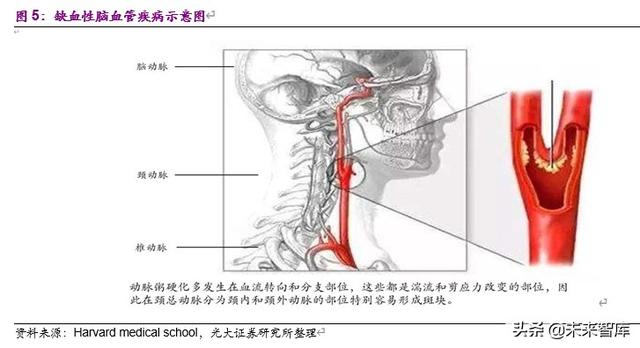 神经介入行业深度报告：介入手术皇冠上的明珠，百亿蓝海即将起航
