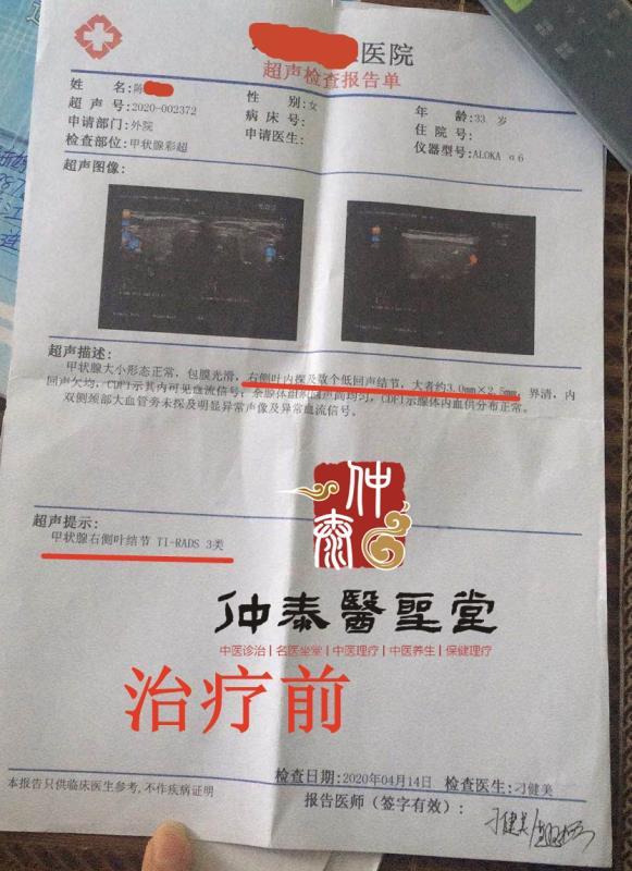 爱郁闷的女孩——甲状腺结节的中医药治疗