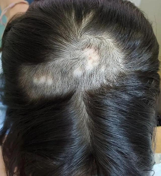 秃头|小学生开始秃头了医生说压力大 杭州这样的病例还不少