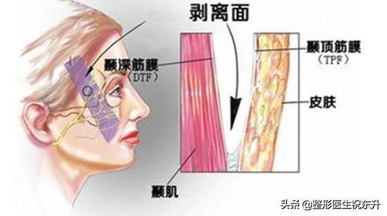 做拉皮手术几年后会怎样？会越拉越松吗？先做好心理准备