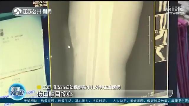 好危险！两岁男童误启电动车 翻车缝了近60针