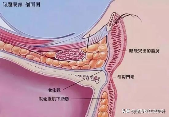 医生不会说的 | 40岁祛眼袋能维持多久？1、2年后会"复发"吗？