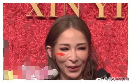 萧亚轩的脸终于恢复正常，曾被质疑过度改造像“巫婆”