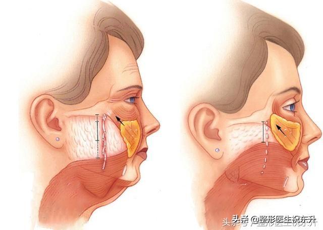 拉皮手术后的紧绷感多久会消失？(内附求美者真实感受分享)