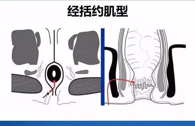 渭南市第二医院外五科完成两例肛瘘括约肌间瘘道结扎术(LIFT)