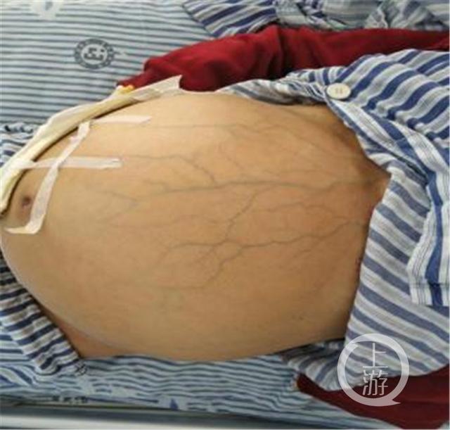 什么情况？！中年女子“大肚子”腹围堪比临盆