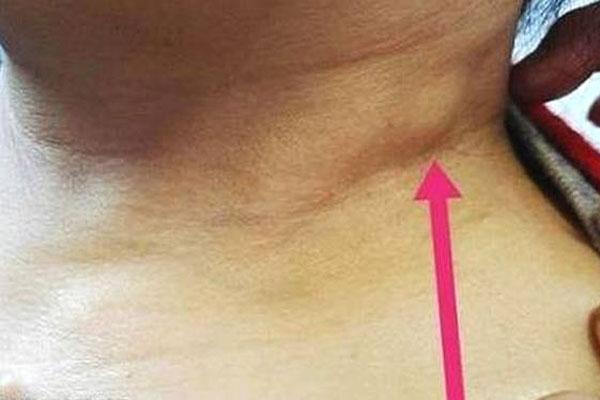 什么是“甲状腺结节”？如何才能有效避免结节“病变”?