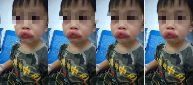 过敏|男孩吃葡萄过敏肿成嘟嘟嘴 比撸铁后肌肉充血还要猛