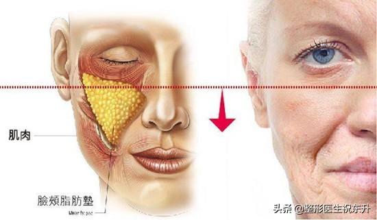 47岁，做过2次面部线雕，后来怎么样了？