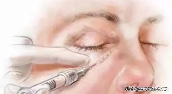 做完面部提升手术后，还有泪沟怎么办？是医生问题吗？