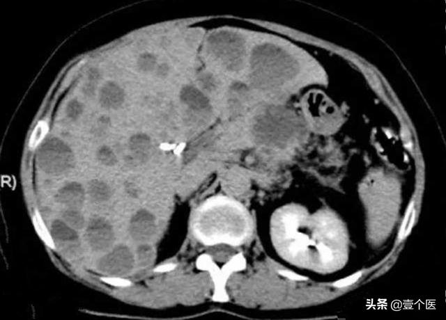 体检时B超或CT查出来的肝脏占位到底是什么？