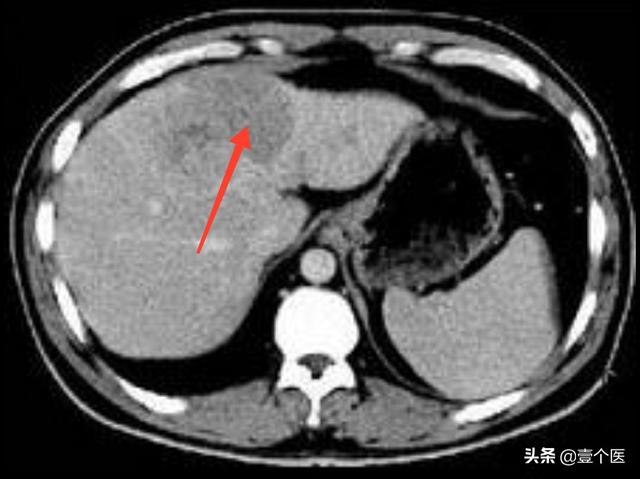 体检时B超或CT查出来的肝脏占位到底是什么？