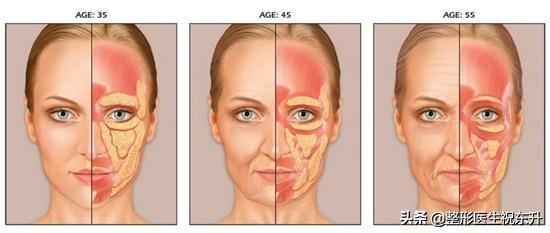 想变年轻，摆脱面部"松、垂、肥"，做中下面部五层提升手术？