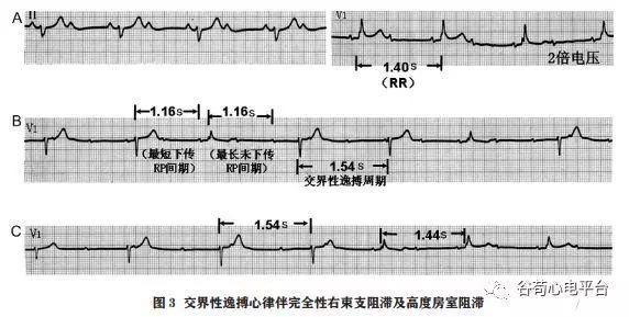 束支阻滞心电图几种特殊现象的分析技巧