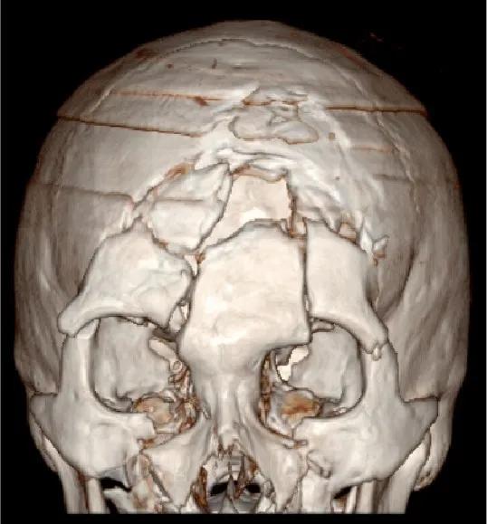 邁普醫學圍盧醫話第5期1——復雜顱面外傷拼圖式一體修復案例剖析