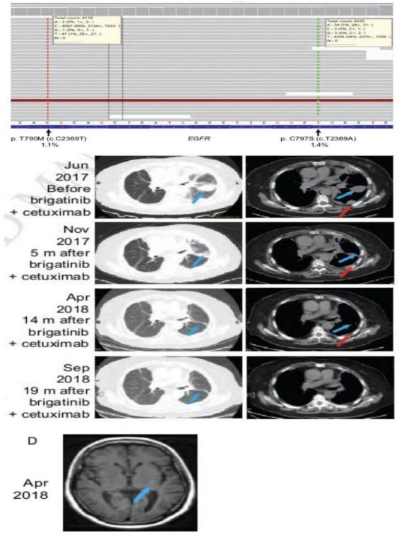 堪称第四代EGFR抑制剂——CH7233163。此次公布的是其临床前数据，体外肿瘤细胞株和小鼠实验均显示，CH72331