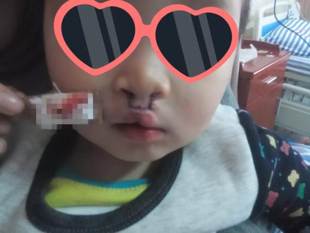 “2020南昌唇腭裂公益救助行动”即日起可报名