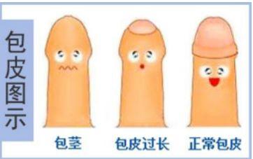 暑假来了，你家男娃割包皮不？这里有攻略哦