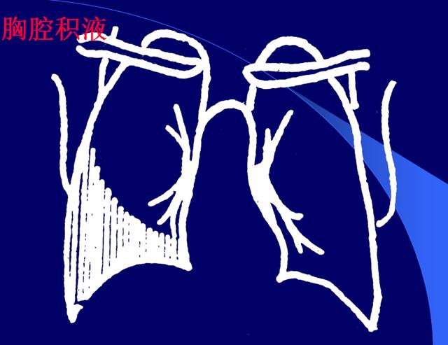 胸腔积液常见的原因有什么？可分为这两点