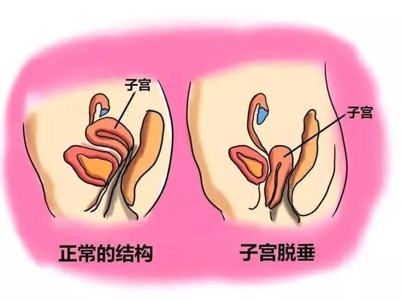 查体时发现杨奶奶宫颈及宫体完全脱出于阴道口,超声检查显示宫壁钙化