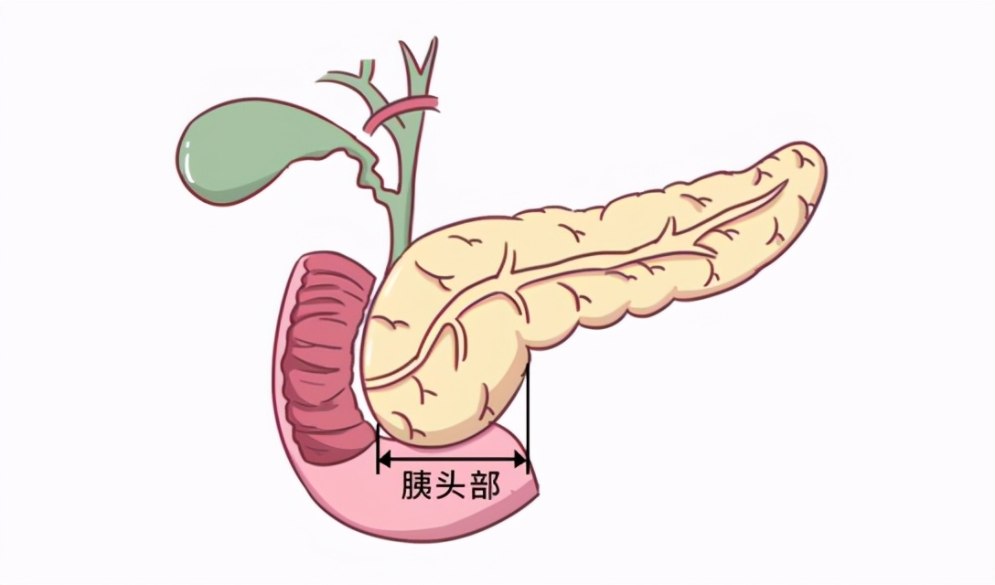 胰腺癌从确诊到死亡不足5个月这些症状都是它的敲门声