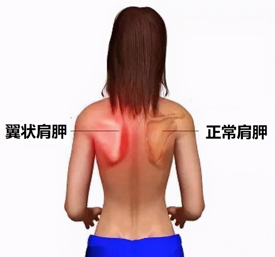 肩胛骨的位置和倾斜(实体为正常的肩胛骨,虚影为翼状肩胛)注意,如果是