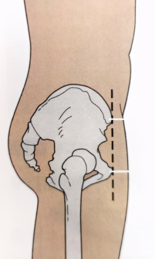 我们可以看看下图,侧面看,骨盆上端的髂前上棘向前超过耻骨,而不是排