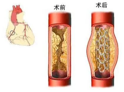 “白菜价”心脏支架来了，欢呼和担忧为何一起来了？