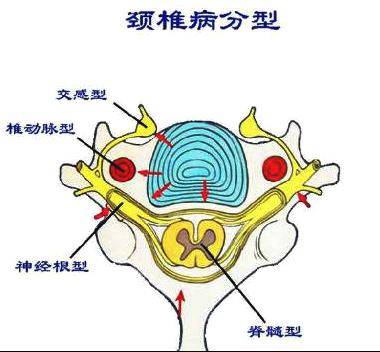 2,神经根型:较多见,常见于30-50岁,是由于突出的颈椎间盘,增生的小