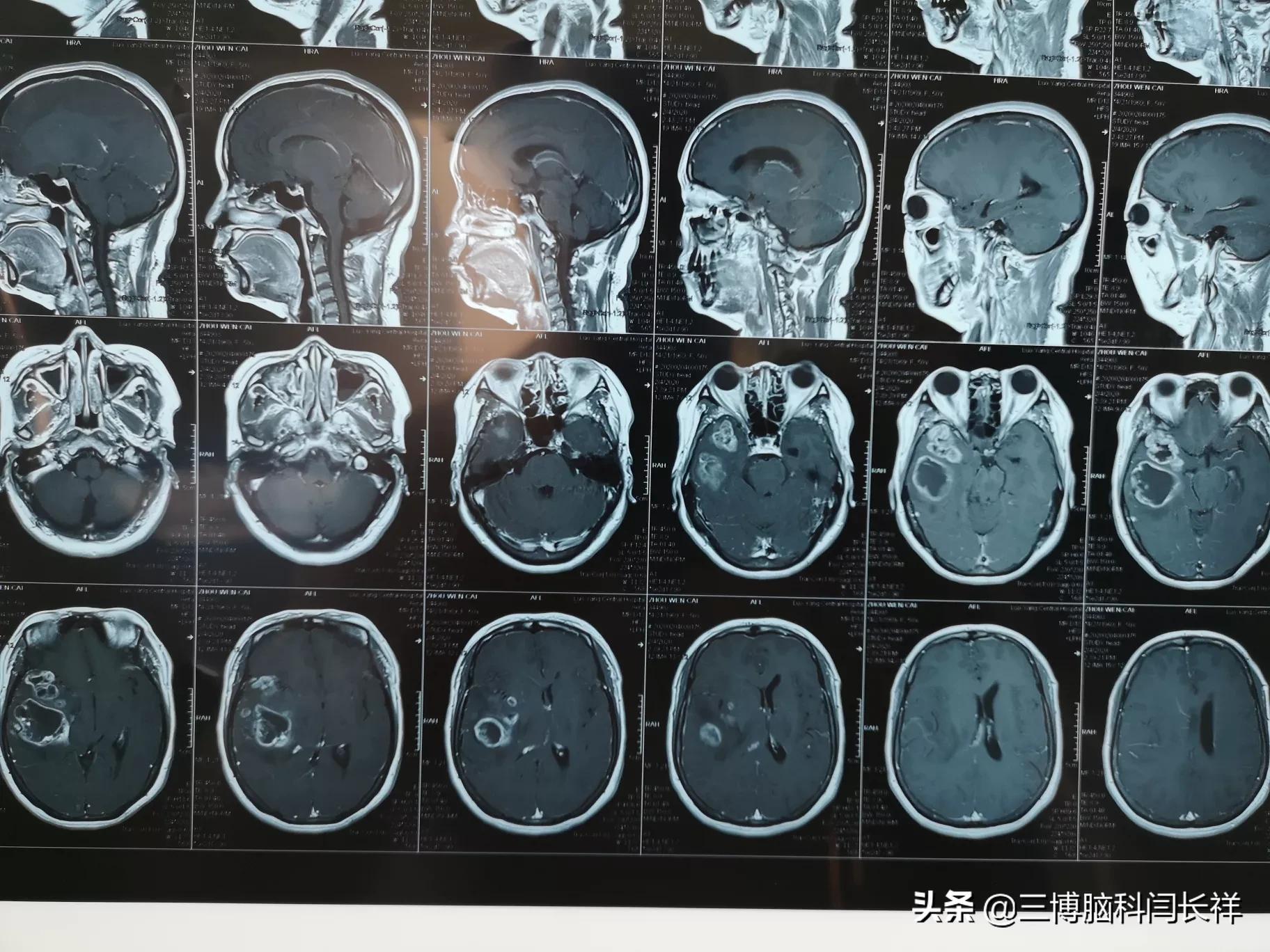 披着高血压伪装的胶质瘤_胶质瘤_胶质瘤症状表现 - 好大夫在线