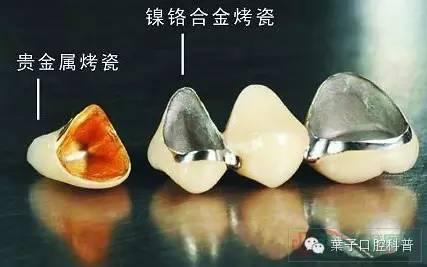 什么是人工牙冠？（下）#葉子口腔科普#