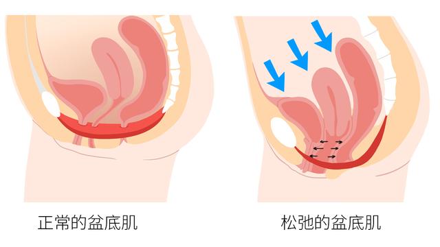 身体出现以上问题都可能是盆底肌松弛惹的祸