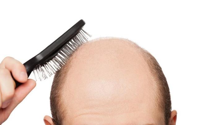 脂溢性脱发是什么样的，怎么治疗才有效，看完你就知道