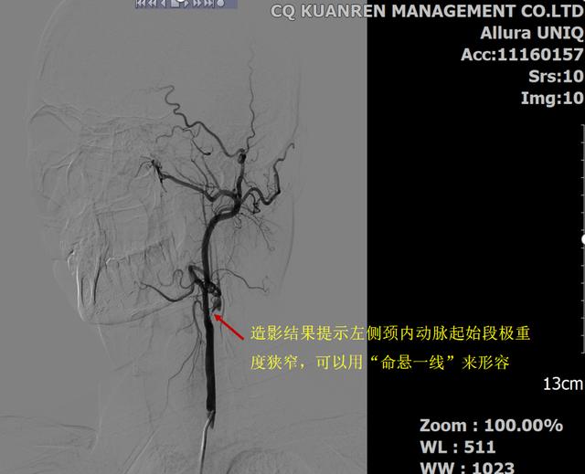 硬核！这家医院接连开展两例四级高难度脑血管介入手术