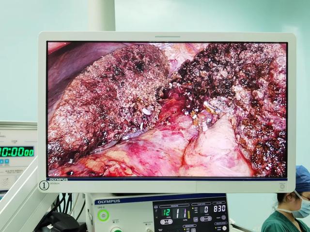 树兰（杭州）医院肝胆胰外科  成功完成一例腹腔镜右半肝切除术
